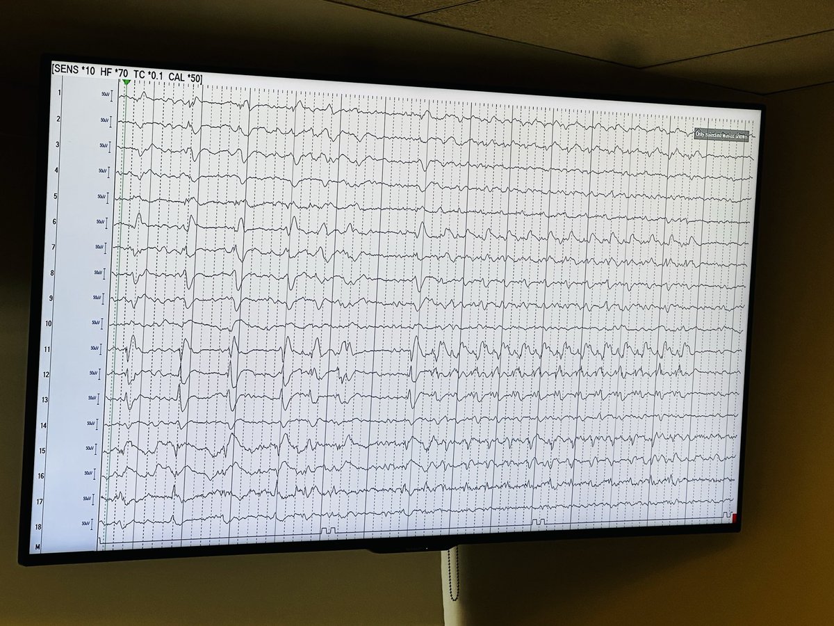 Case Western Reserve Univ/UH Epilepsy Program tweet media