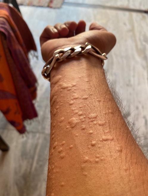 Visited her boyfriend last weekend and she got this.
What’s the cause of this and how can it be cleared off