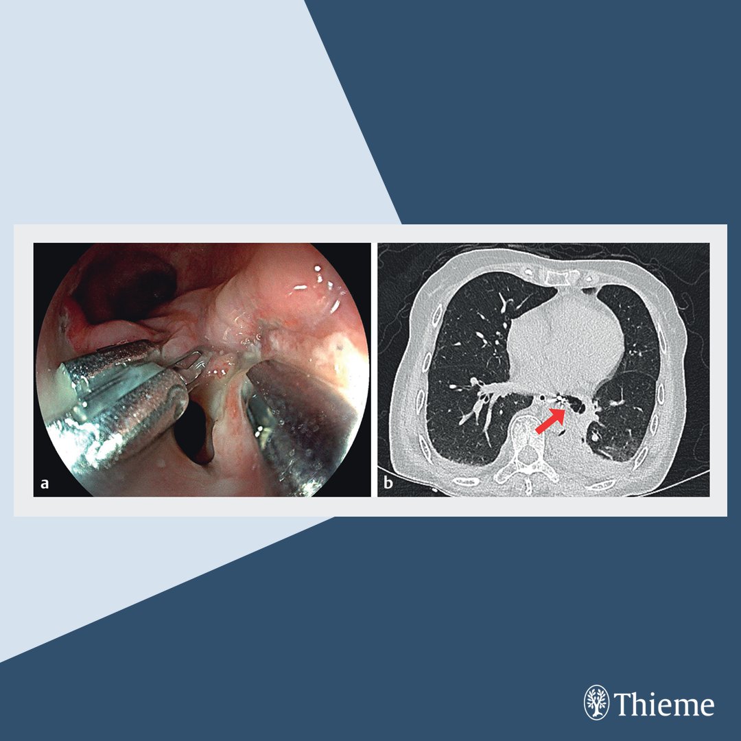 endoscopyjrnl's tweet photo. #EVideo: A successful treatment of esophagomediastinal fistula following endoscopic submucosal dissection: tube-intube endoscopic vacuum therapy
Find the full text and video here: https://t.co/1Ivg4K6Bhz
Xiaoyan Zhang et al. https://t.co/AVNtoBqPoK