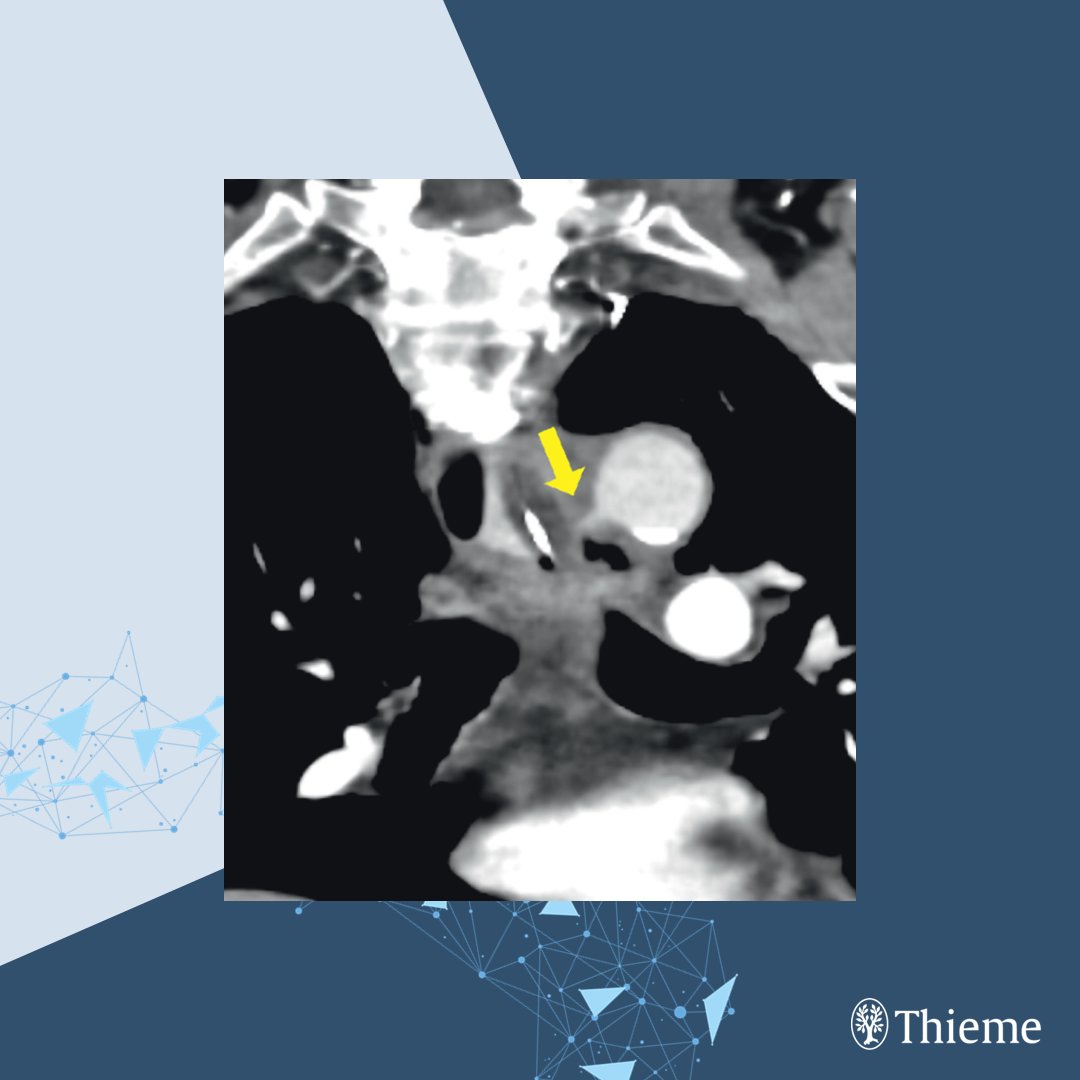 endoscopyjrnl's tweet photo. #EVideo: Endoscopic balloon tamponade for massive bleeding from aorto-esophageal fistula: a simple technique for rapid hemostasis
Find the full text and video here: https://t.co/4hUmdN0yYW
Yuichiro Mikuriya et al. https://t.co/1EY6KwicXY