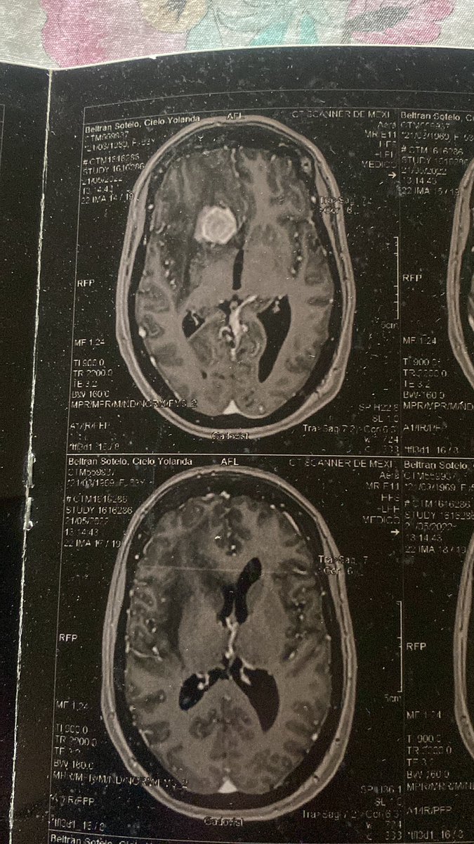 Aún sigo luchando, cualquier ayuda cuenta, gracias por compartir 🙏🙏🏻👇🏻👇🏻👇🏻👇🏻

Buenos días, comunidad de X 🙏❤️  
Soy Yolanda Beltrán (<a href="/CieloYolandaBe1/">Yolanda Beltrán S</a>), desde México, luchando cada día contra un tumor cerebral que me roba la tranquilidad. Las convulsiones son constantes y muy