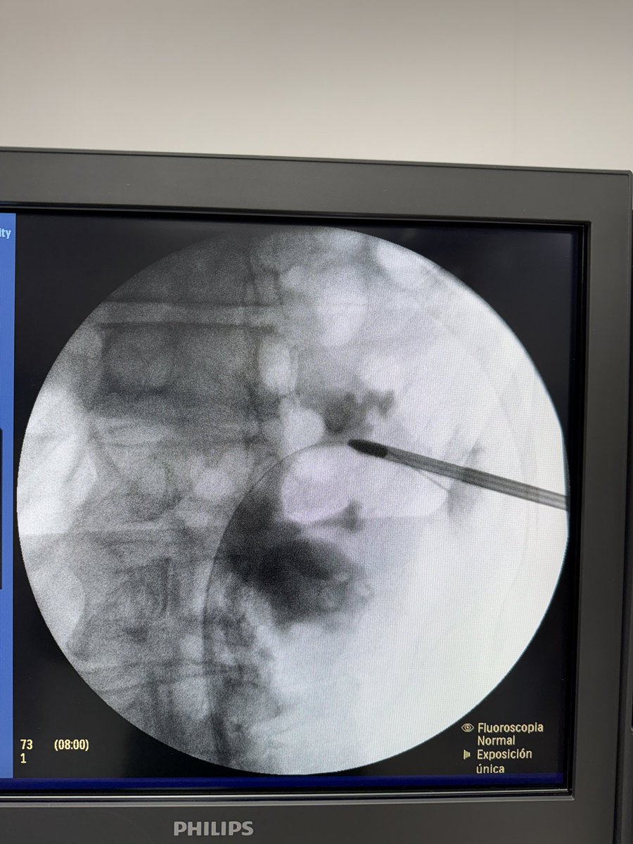 urotelio's tweet photo. The simplified 0-90 technique developed by @urobraulio is the state of the art in percutaneous access. 

This case is the perfect example; a complex upper pole stones, cleared via supine #MiniPCNL with the precision of puncture the selected site. https://t.co/KWdnEK4Vl3
