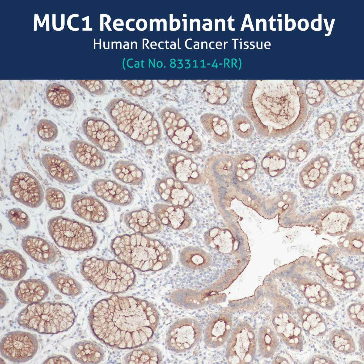 Proteintech's tweet photo. #TissueTuesday
We’re spotlighting our MUC1 Recombinant Antibody, in honor of colorectal cancer awareness month.
Our MUC1 Recombinant Antibody can be used in chromogenic IHC experiments to study tumor progression in colon and rectal tissues.
Learn more: https://t.co/hiflO5socI https://t.co/VYZmZGPSQp