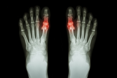 FusionFoot's tweet photo. Gout in Teenagers https://t.co/9CDHjVbxFp https://t.co/62SlHTpd34