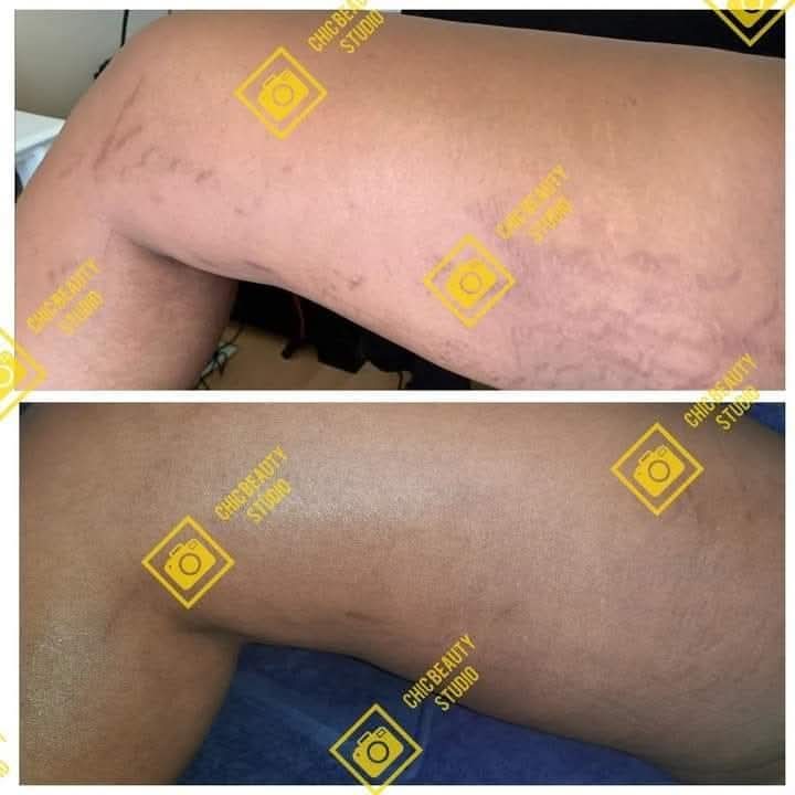 chicbeauty_chic's tweet photo. “Nothing worked for my stretch marks…”
This is something we hear from many clients before they start treatment at Chic Beauty Studio.
The good news? There ARE treatments that can help reduce their appearance and improve your skin
Treatment: R800 – R1850
📞0812194333
#BBMzansiS6 https://t.co/EuZgMq5JPE