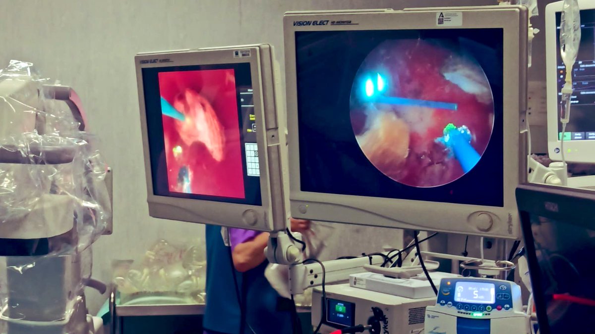 ALeonSalas's tweet photo. Seguimos aprendiendo. ECIRS izquierda de litiasis coraliforme completa, doble acceso percutáneo por cáliz inferior y superior. Litofragmentación con láser Thulio y Holmium simultáneamente. Muchas gracias @UrologiaHJRJ @IsMohedano @InfoAeu @hujuanramon  #Huelva #Litiasis #Urología https://t.co/UcPFfueJ1d