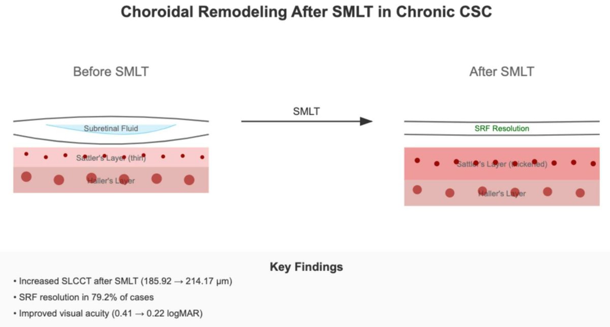 JCM_MDPI's tweet photo. #mdpijcm
#ResearchPaper Sharing
๐#Choroidal Remodeling After #SubthresholdMicropulseLaser in Chronic Central Serous Chorioretinopathy: Short-Term Outcomes
๐https://t.co/vRw540YMoV
@MediPharma_MDPI
@OCT; #CSC https://t.co/cdcOykVjdh
