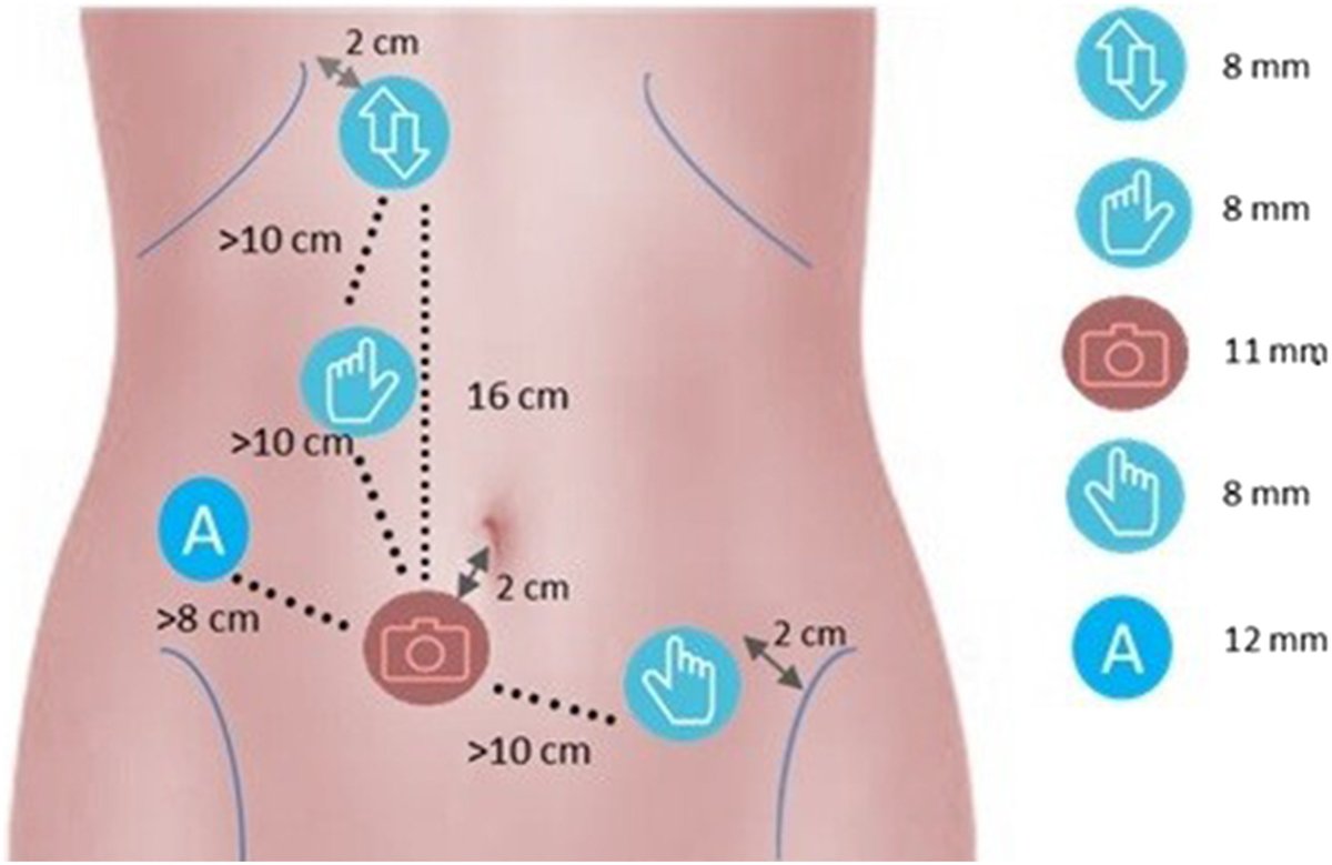 Laparoscopic, Endoscopic and Robotic Surgery tweet media