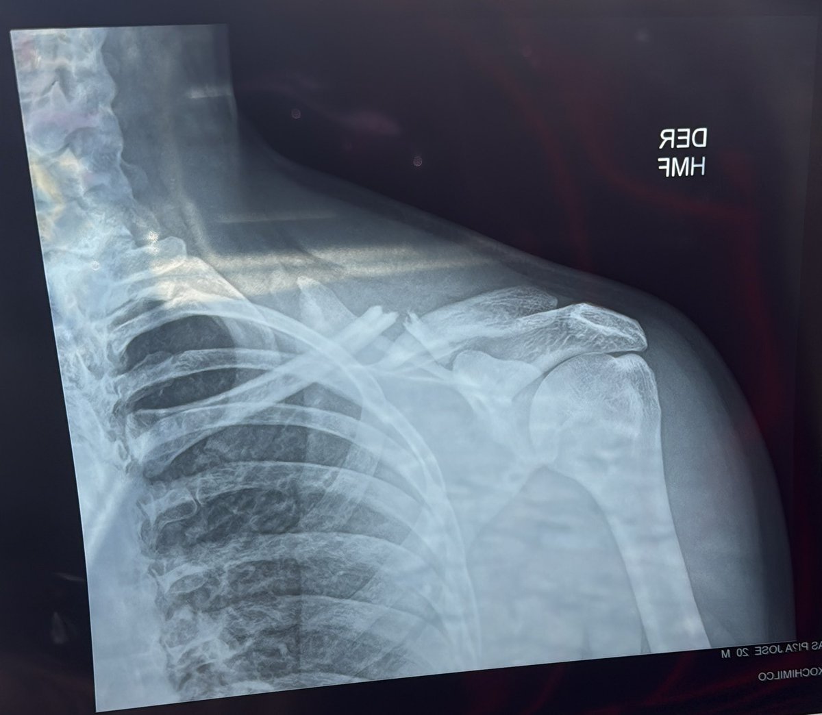 Eso fue atacar cuál cohete o correr como bólido ?