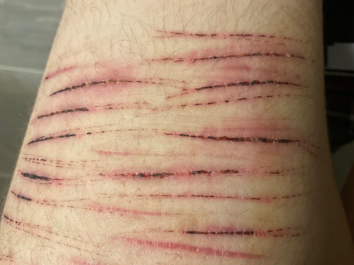 Sshheedddttwwwt's tweet photo. I’m lowkey proud of how my leg looks 😝 last post for a bit cuz my mom found out and I need to take a break 🙄 #shtwt #shhhh #slightlyhealed #sh #blockdontreport https://t.co/Q8bscM5IPt