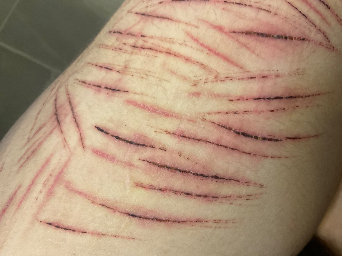 Sshheedddttwwwt's tweet photo. I’m lowkey proud of how my leg looks 😝 last post for a bit cuz my mom found out and I need to take a break 🙄 #shtwt #shhhh #slightlyhealed #sh #blockdontreport https://t.co/Q8bscM5IPt