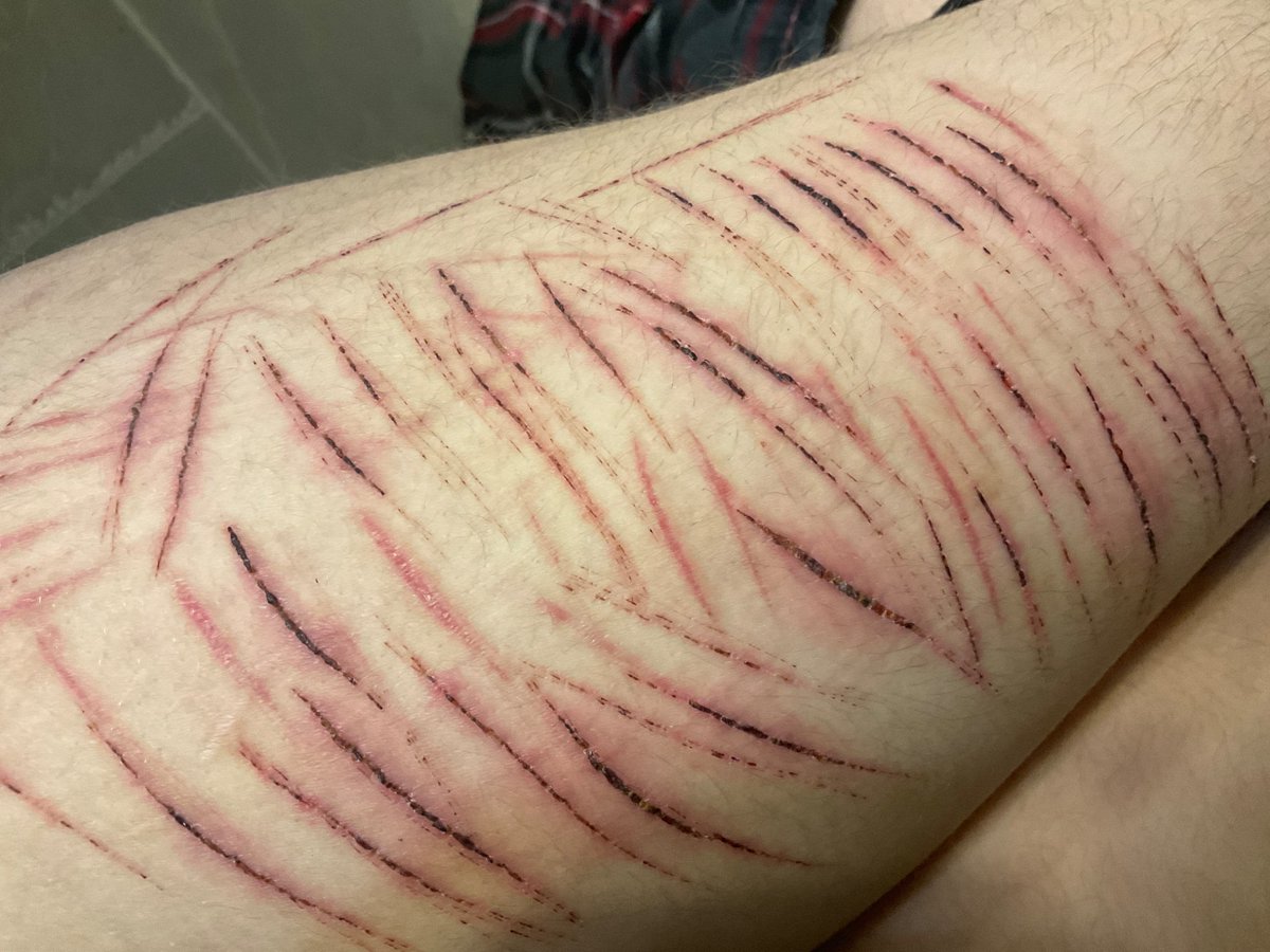 Sshheedddttwwwt's tweet photo. I’m lowkey proud of how my leg looks 😝 last post for a bit cuz my mom found out and I need to take a break 🙄 #shtwt #shhhh #slightlyhealed #sh #blockdontreport https://t.co/Q8bscM5IPt