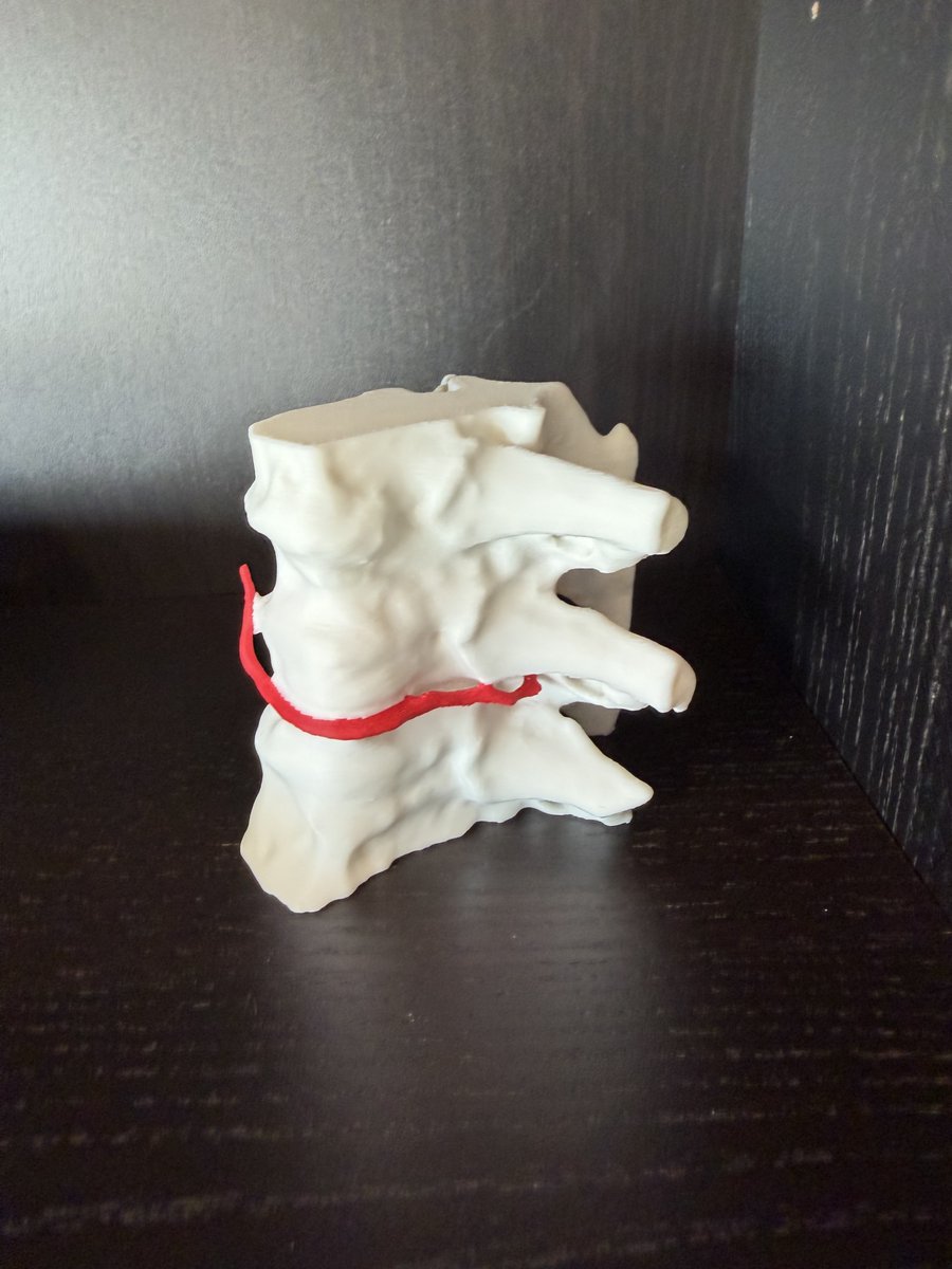 AndrewCallenMD's tweet photo. A CSF-venous fistula… in your hand.

My brother 3D-printed this model from a volume rendering created by our 3D lab tech Amanda from a dynamic CT myelogram.

I think we should be doing more of this for patient education: there’s something powerful about visualizing what’s happening inside your body.