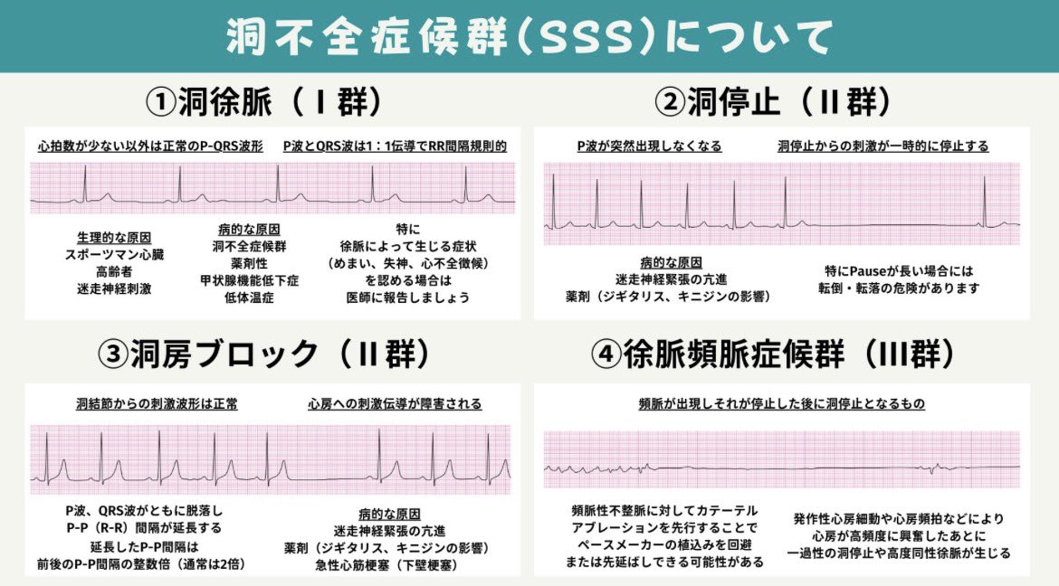 ecgkuma's tweet photo. 心電図で
徐脈を見た瞬間、

P波を見ていますか？

ここを見ないと
徐脈は整理できません。

徐脈性不整脈は
大きく2つに分かれます。

① 洞結節の問題
② 房室伝導の問題

違いは
P波とQRSの関係。

⸻

■ 洞不全症候群（SSS）

洞結節が
うまく興奮を作れない。

つまり
P波が出ない。

代表例
・洞徐脈
・洞停止
・洞房ブロック
・徐脈頻脈症候群

問題は
発生（洞結節）。

⸻

■ 房室ブロック

P波は出ている。

でも
心室へ伝わらない。

つまり
P波はあるのに
QRSが遅れる。

問題は
伝導（AV結節〜ヒス束）。

⸻

徐脈で迷ったら
まずこれ。

P波はあるか？

ある
→ 房室ブロック

ない
→ 洞不全症候群

この分岐だけで
徐脈の見方は
一気に整理されます。

まずP波。

ここから見ると
徐脈の鑑別は崩れません。

保存しておくと
徐脈の鑑別で迷わなくなります。
