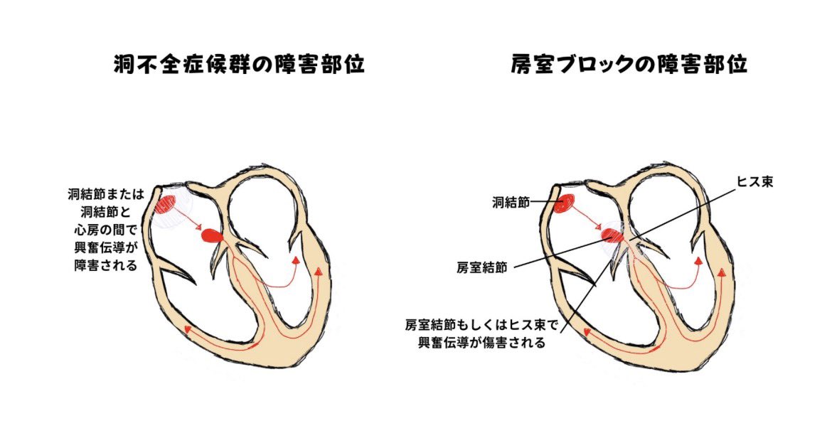 ecgkuma's tweet photo. 心電図で
徐脈を見た瞬間、

P波を見ていますか？

ここを見ないと
徐脈は整理できません。

徐脈性不整脈は
大きく2つに分かれます。

① 洞結節の問題
② 房室伝導の問題

違いは
P波とQRSの関係。

⸻

■ 洞不全症候群（SSS）

洞結節が
うまく興奮を作れない。

つまり
P波が出ない。

代表例
・洞徐脈
・洞停止
・洞房ブロック
・徐脈頻脈症候群

問題は
発生（洞結節）。

⸻

■ 房室ブロック

P波は出ている。

でも
心室へ伝わらない。

つまり
P波はあるのに
QRSが遅れる。

問題は
伝導（AV結節〜ヒス束）。

⸻

徐脈で迷ったら
まずこれ。

P波はあるか？

ある
→ 房室ブロック

ない
→ 洞不全症候群

この分岐だけで
徐脈の見方は
一気に整理されます。

まずP波。

ここから見ると
徐脈の鑑別は崩れません。

保存しておくと
徐脈の鑑別で迷わなくなります。
