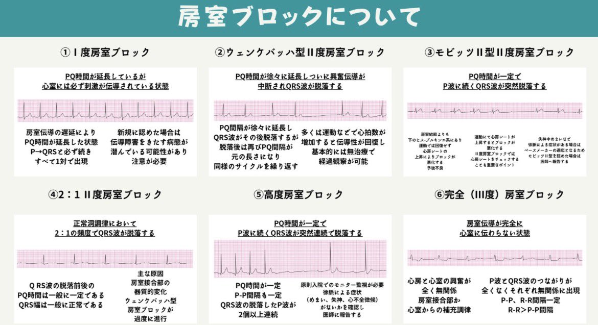 ecgkuma's tweet photo. 心電図で
徐脈を見た瞬間、

P波を見ていますか？

ここを見ないと
徐脈は整理できません。

徐脈性不整脈は
大きく2つに分かれます。

① 洞結節の問題
② 房室伝導の問題

違いは
P波とQRSの関係。

⸻

■ 洞不全症候群（SSS）

洞結節が
うまく興奮を作れない。

つまり
P波が出ない。

代表例
・洞徐脈
・洞停止
・洞房ブロック
・徐脈頻脈症候群

問題は
発生（洞結節）。

⸻

■ 房室ブロック

P波は出ている。

でも
心室へ伝わらない。

つまり
P波はあるのに
QRSが遅れる。

問題は
伝導（AV結節〜ヒス束）。

⸻

徐脈で迷ったら
まずこれ。

P波はあるか？

ある
→ 房室ブロック

ない
→ 洞不全症候群

この分岐だけで
徐脈の見方は
一気に整理されます。

まずP波。

ここから見ると
徐脈の鑑別は崩れません。

保存しておくと
徐脈の鑑別で迷わなくなります。