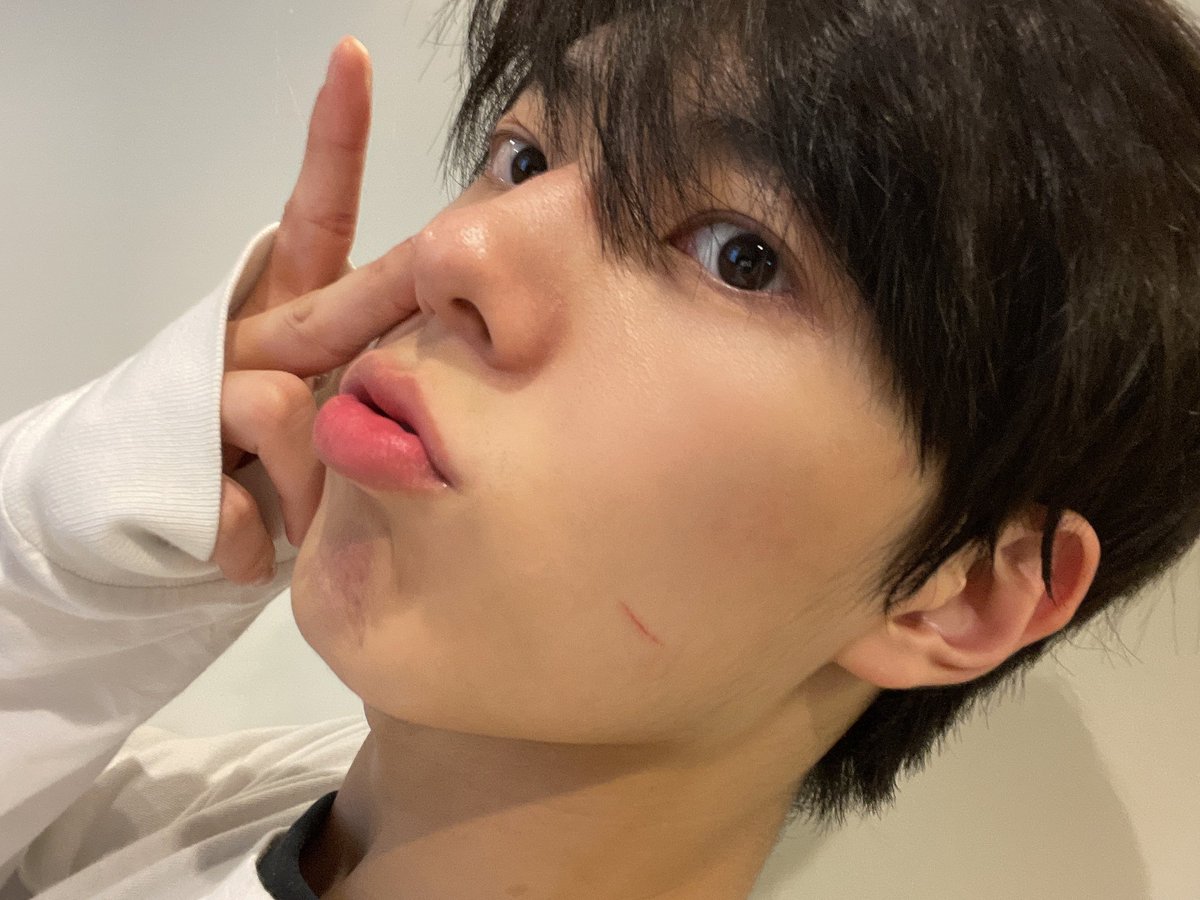 4__0dong's tweet photo. 면도 처음해봐서 볼에 상처 났대 미친 진짜진짜진짜 아간가봐 어떡해 https://t.co/DV4jnNcxK2