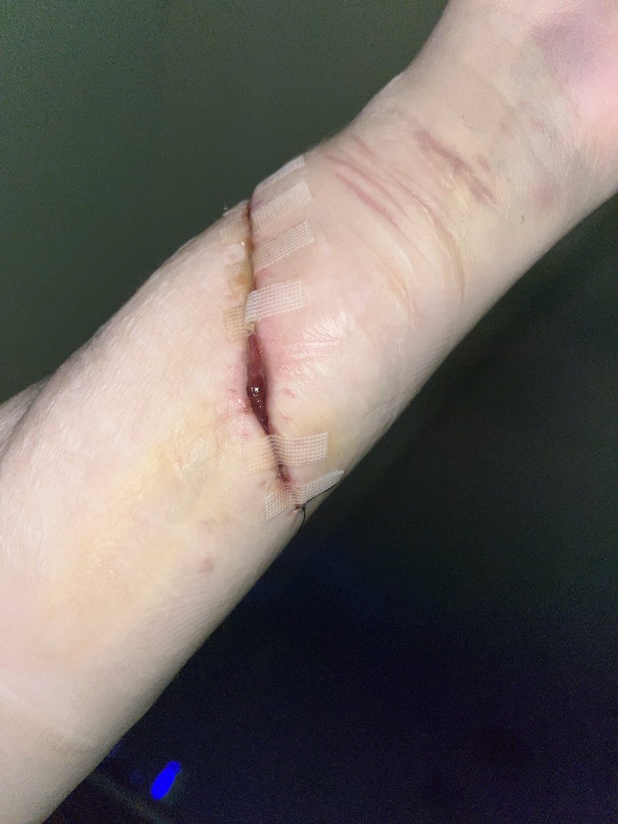 cattcat0's tweet photo. i hate how small the scar is. i cut so deep in one swipe hitting some muscle and an artery. i didn't even feel. it looked like my arm was almost cut in half. i tore the stitches out to reopen it but they just closed it again. i wish i bleed out. https://t.co/0eW2ET5tfH