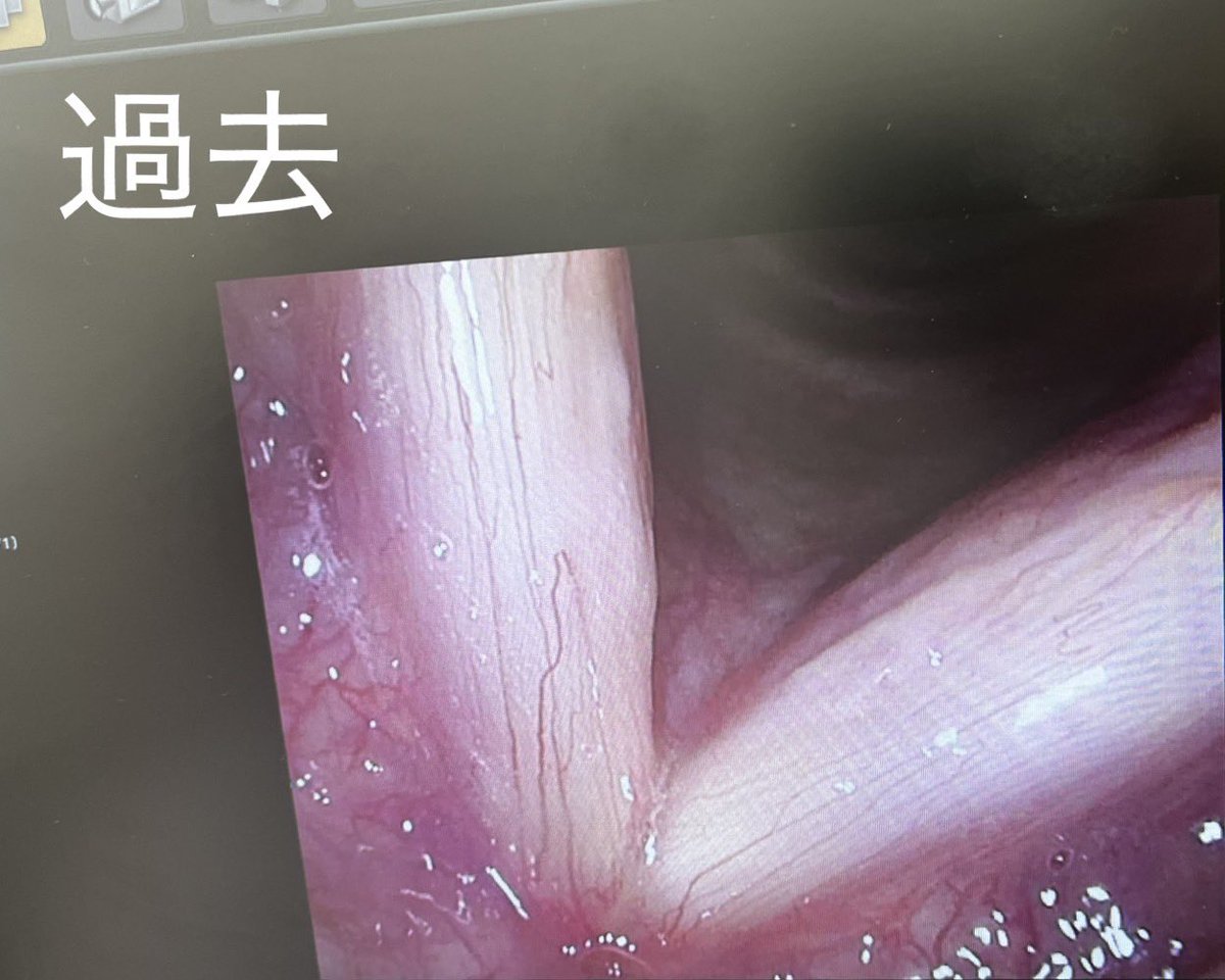 72m3arc888's tweet photo. 皆様にとって
『声』ってどんな存在ですか？

私のとって声は心臓と同じくらい
大事だと感じています。

それでも耳鼻科関係の疾患は、
就労不可というのが診断を出すことが難しいと知りました。

声を使う仕事だとしてもです。

働けるか働けないかは、
身体が動くか動かないかで判断する。 https://t.co/UigdSc6kpZ