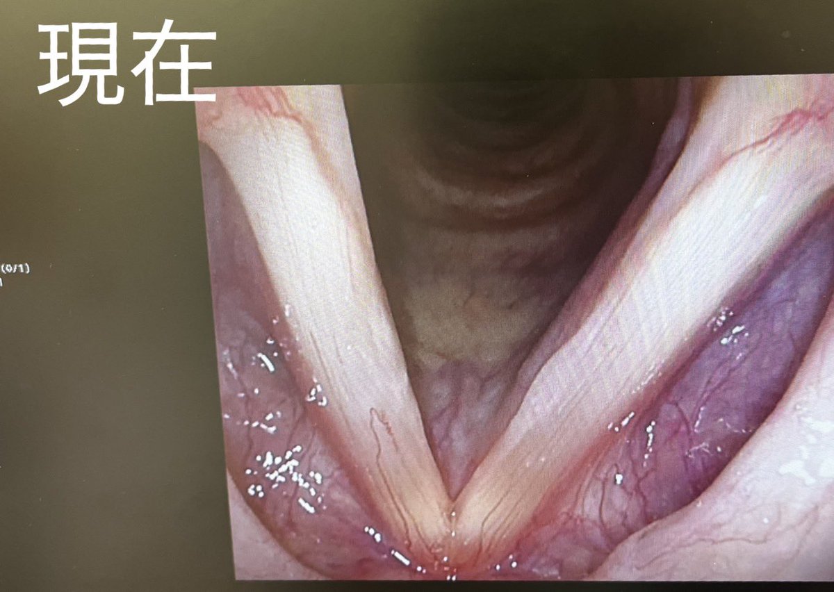 72m3arc888's tweet photo. 皆様にとって
『声』ってどんな存在ですか？

私のとって声は心臓と同じくらい
大事だと感じています。

それでも耳鼻科関係の疾患は、
就労不可というのが診断を出すことが難しいと知りました。

声を使う仕事だとしてもです。

働けるか働けないかは、
身体が動くか動かないかで判断する。 https://t.co/UigdSc6kpZ