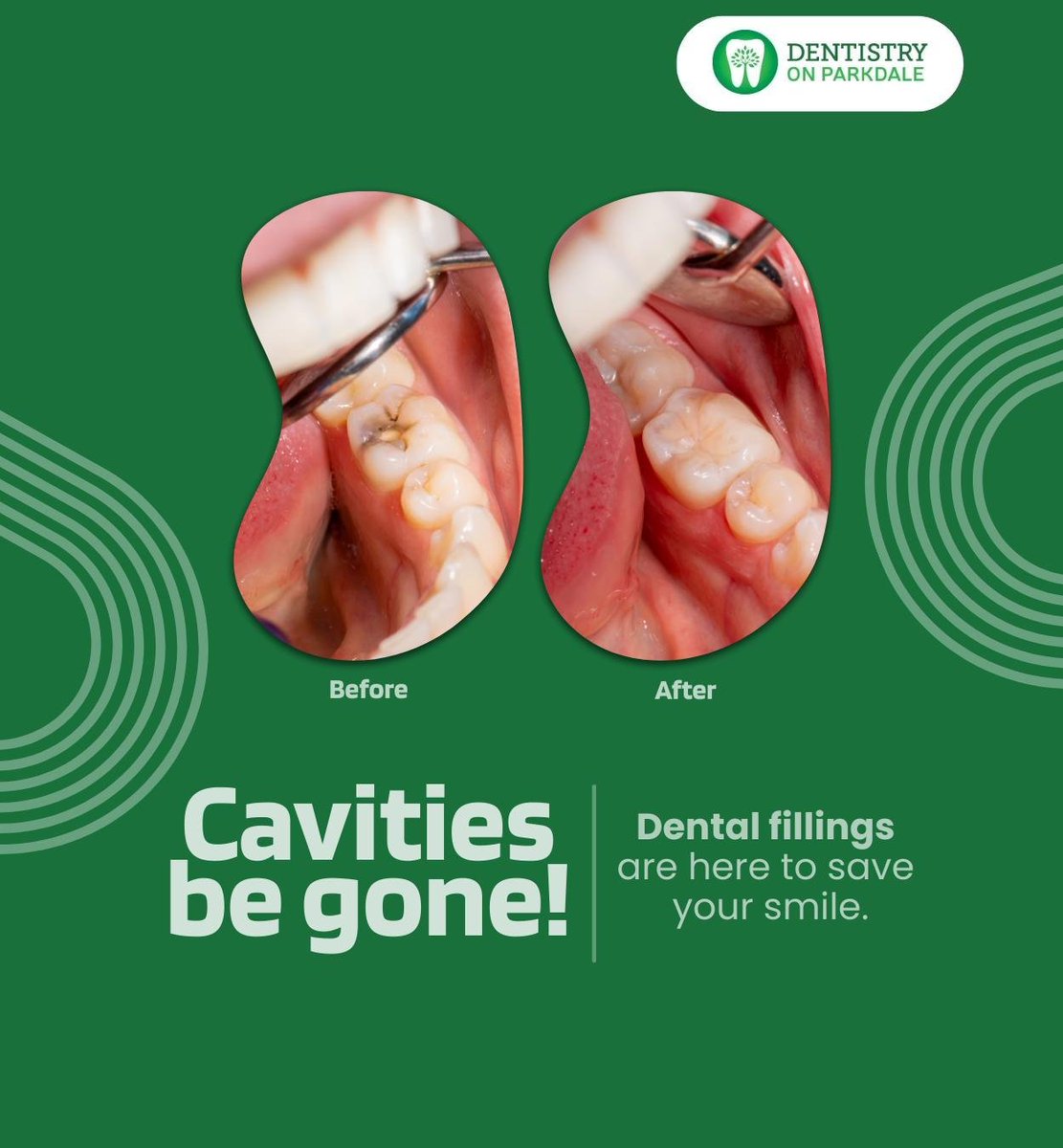 Is your tooth feeling a little down because of cavities? Dental fillings to the rescue. Fillings can repair your teeth and preserve them for a healthy smile.
.
.
.
dentistryonparkdale.com

#dentalfillings #cavityfilling #dentalrestoration #hamilton #ON #dentistryonparkdale
