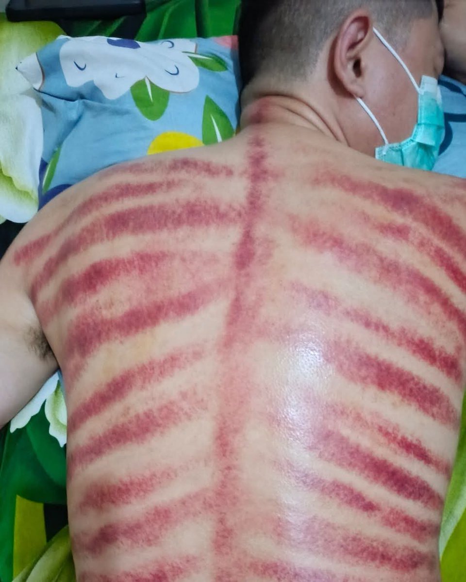 TopVijat's tweet photo. Yang pegal2 chat aja🙏
Bisa juga kerokin pijat sensual dll‼️ https://t.co/xBmJ5i9N34