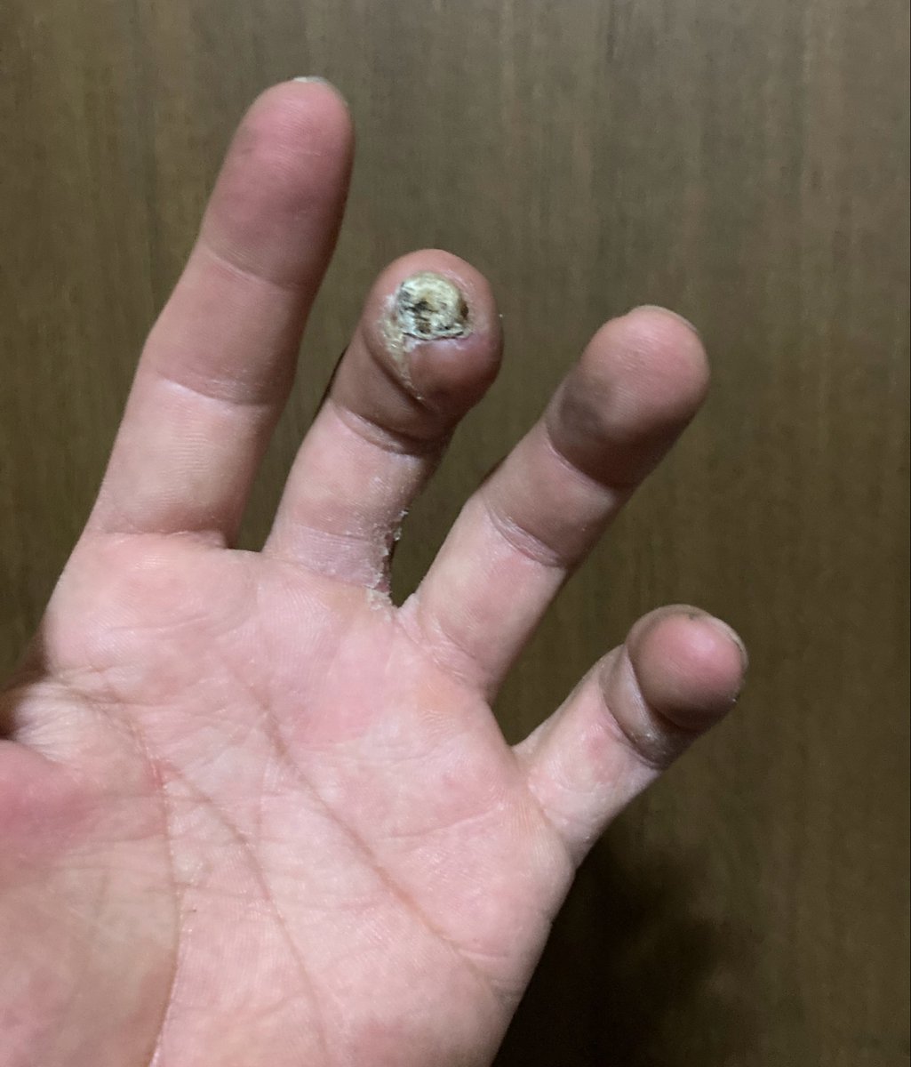 tomoguitars's tweet photo. 指先に爪の残骸があるので、弦が押さえられない！ https://t.co/W3CsNa1SJs