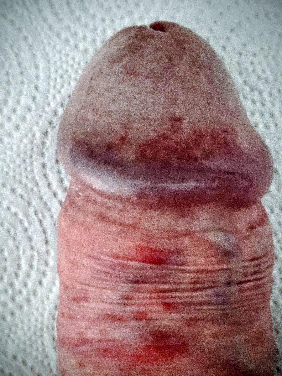 Recently UPGRADED ... syphilis kick-off.