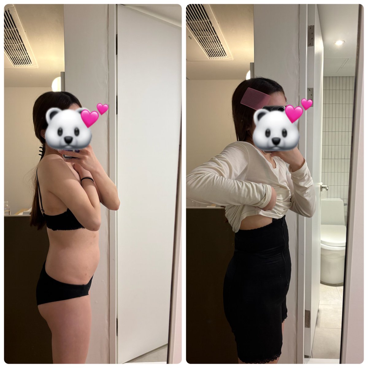 imn_mq's tweet photo. 腹部脂肪吸引、パンティーライン脂肪吸引、骨盤脂肪移植した直後です🧏🏻💕回復室が暖かかったのでいつも震えが止まらないわたしでも震えることなく過ごせました！🎀

#レアート #チェ院長 https://t.co/yxgRq5FDx0
