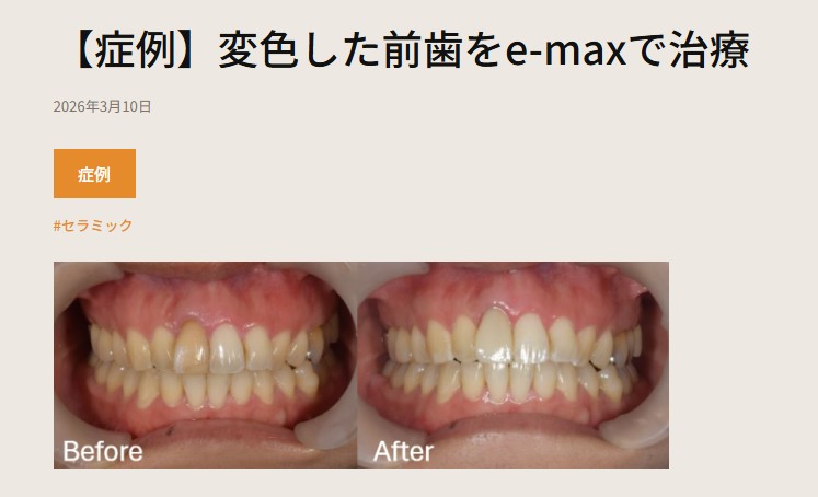 setagaya_DC's tweet photo. 症例をUPしました！！

【症例】変色した前歯をe-maxで治療
https://t.co/iqu6Dk3wwV

#歯科医院 #歯医者⁠
#せたがや歯科室 #松陰神社 #松陰神社前 ＃症例UP #セラミック https://t.co/fJedNeWaNa