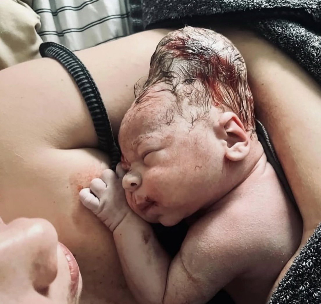 Sage_medics's tweet image. A 38-weeks-gestational-age infant is born vaginally to a 29-year-old G2P1 mother after an uncomplicated labor. 

The baby is delivered with intact membranes, no meconium, and good cry at birth. Immediately after delivery, the newborn is placed skin-to-skin on the mother’s