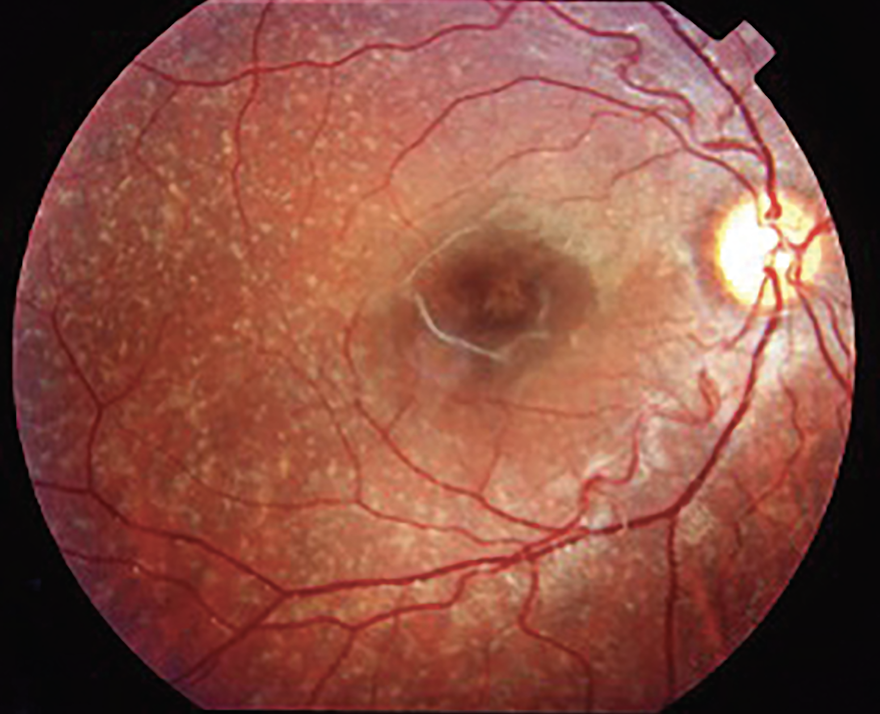 RevOphth's tweet photo. The Inherited Retinal Disease Pipeline

Nearly 10 years after Luxturna’s approval, retinal specialists share the advances—and setbacks—that are moving research forward:
https://t.co/Pk92lUjf5C

#ophthalmology #ophthalmologist #eyecare #retina #retinaspecialist #retinaldisease https://t.co/E6PwcBzDLS