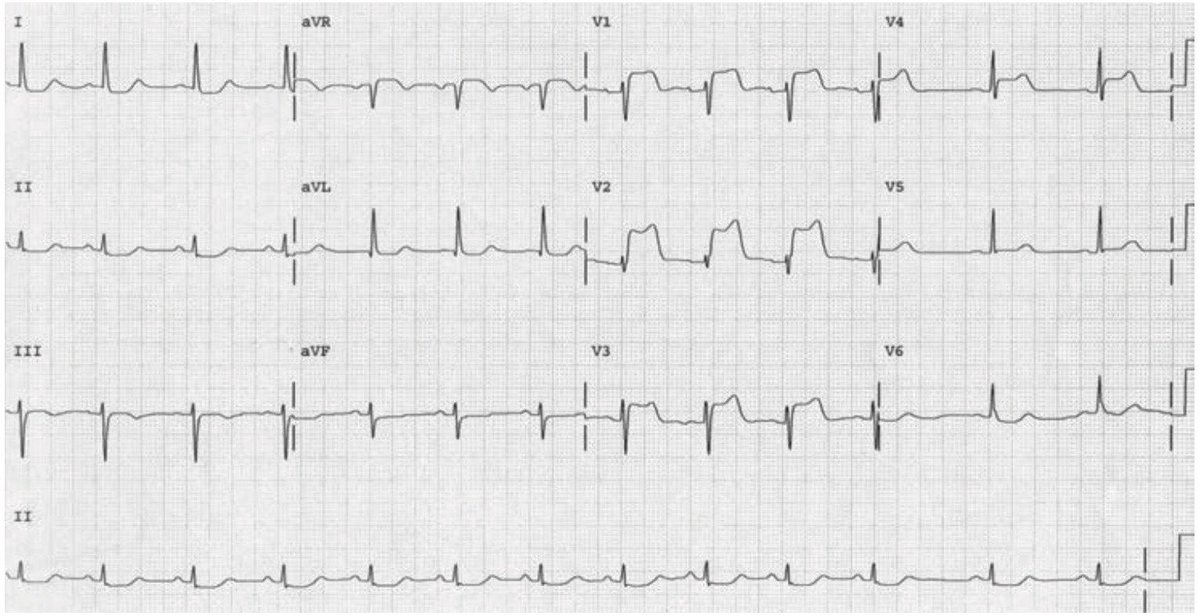 Dr_Shiv_kumar_'s tweet photo. ECG alert 🚨 

Clinical ECG case 🩺 
 
A 56-year-old man presents with 90 minutes of severe retrosternal chest pain, pressure-like, radiating to the left arm, associated with diaphoresis and nausea. Pain began during exertion and did not relieve with rest.
He reports intermittent exertional chest discomfort over the past few weeks. High-sensitivity Troponin-I:

How would you interpret this ECG & what’s the culprit artery here? 

#MedTwitter #MedX #ECG #Cardiology