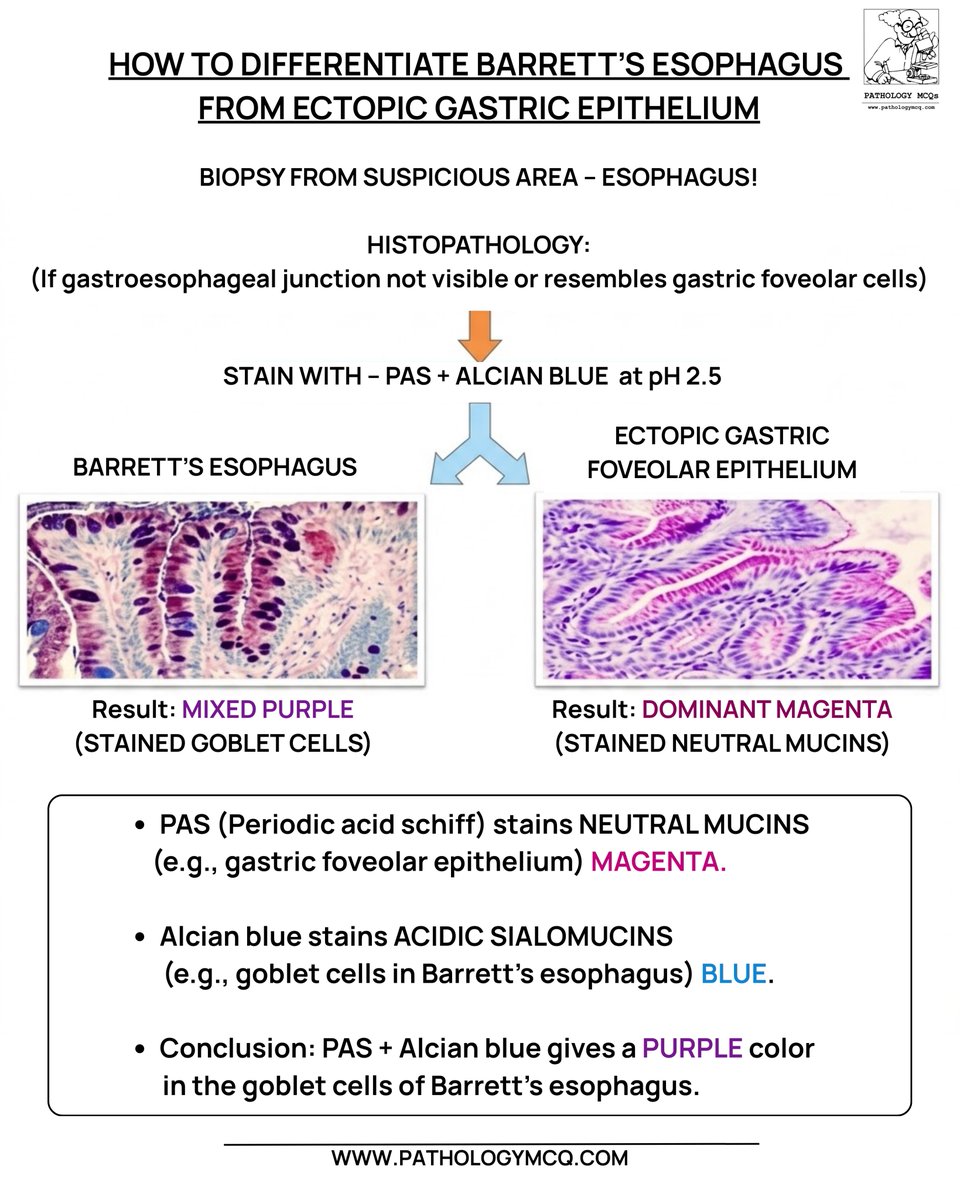 Pathology_mcqs's tweet photo. 🔬 Barrett’s esophagus or ectopic gastric epithelium?
🟪 PAS stains neutral mucins → magenta (gastric foveolar epithelium)
🔵 Alcian Blue stains acidic mucins → blue (goblet cells)
#pathology #histopathology #barrettesophagus #gipathology #specialstains #alcianblue #passtain https://t.co/l7SaTV1E6R
