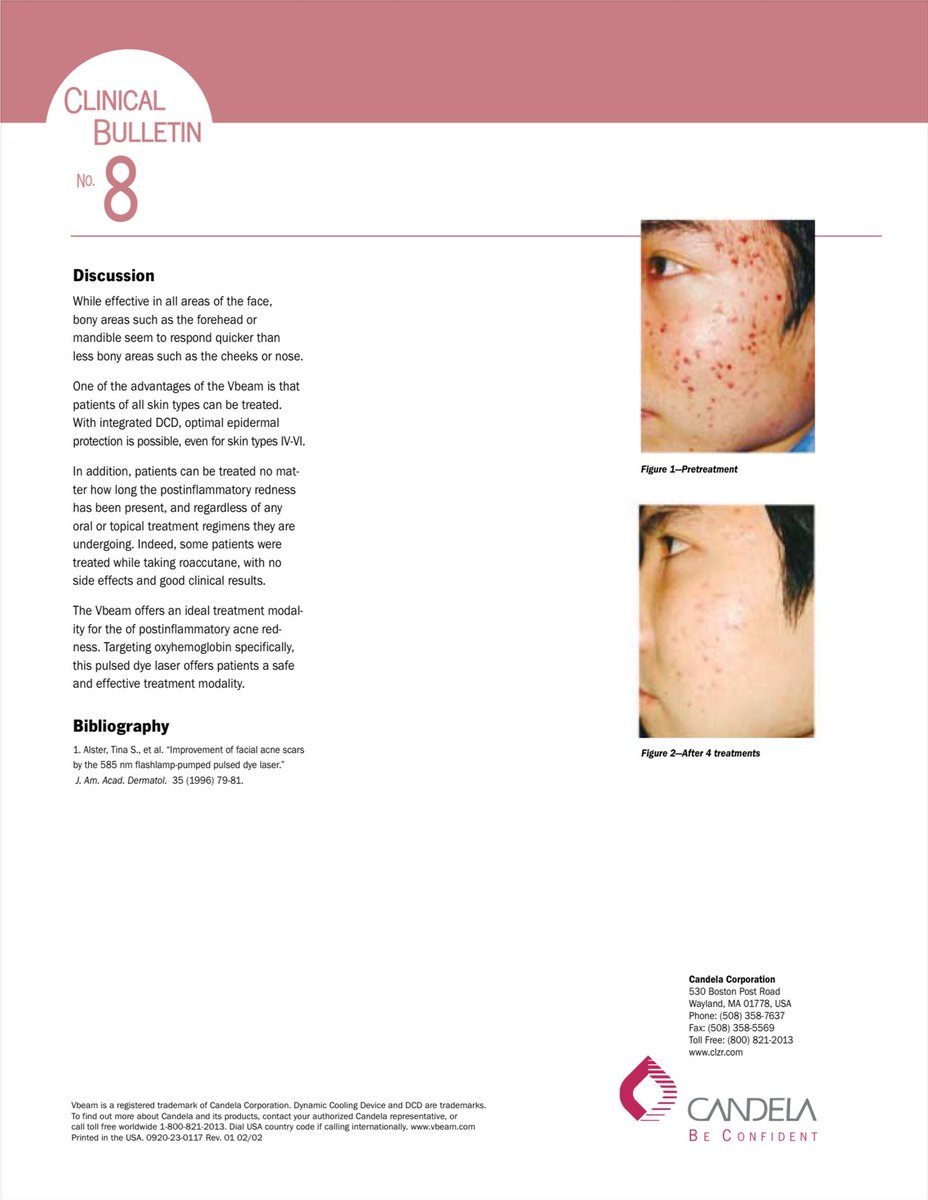 มายกมือสนับสนุน

พร้อมขออนุญาตแนบบทความแรกสุด ที่มีการประยุกต์ใช้ Vbeam®️ laser สำหรับการรักษารอยแดงสิวในคนไทย โดยอาจารย์แพทย์ผิวหนังคนไทย ศิษย์สายตรงของ Prodessor Rox Anderson บิดาแห่งเลเซอร์ของโลกครับ