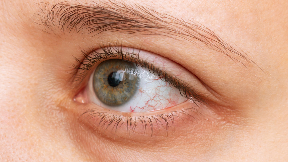 Barraquer tweet media