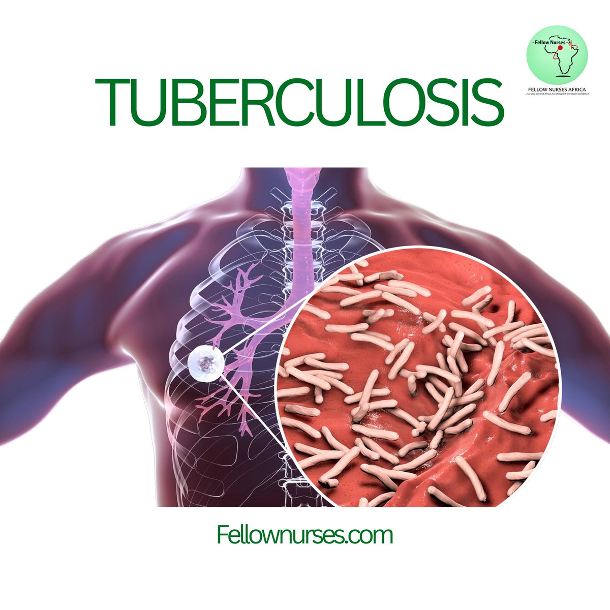 FellowNurses1's tweet photo. Tuberculosis (TB) is a contagious bacterial infection caused by Mycobacterium tuberculosis. It mainly affects the lungs, but it can also affect other parts of the body such as the spine, kidneys, brain, and lymph nodes.
#NursesLife #NursingStudent
https://t.co/PwwdGgTJwL https://t.co/NGQNsKluie