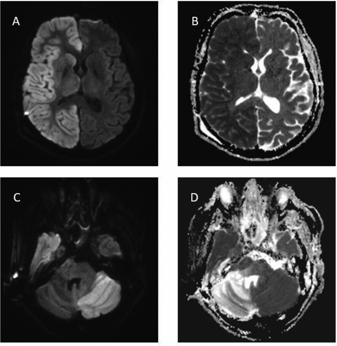 DocNavarrow's tweet photo. 🙆‍♀️A 42-year-old woman with septic shock and coma undergoes brain MRI after status epilepticus. 

🧠Supratentorial cortical abnormalities are present, but the cerebellum shows contralateral involvement despite no primary lesion. 

Which phenomenon explains this crossed pattern? https://t.co/uQWZwmeGQQ