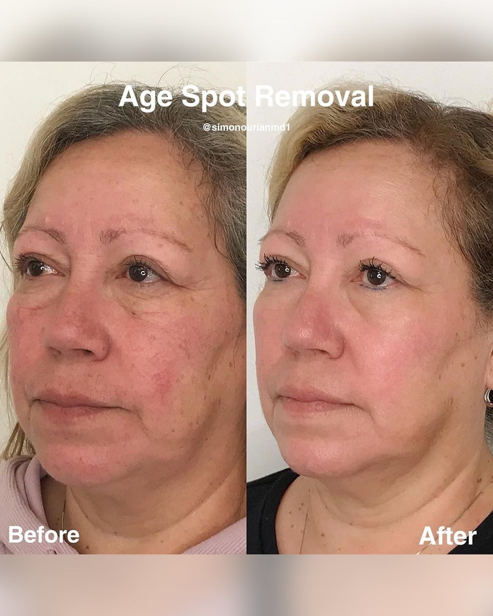 Dr. Simon Ourian - Epione tweet media