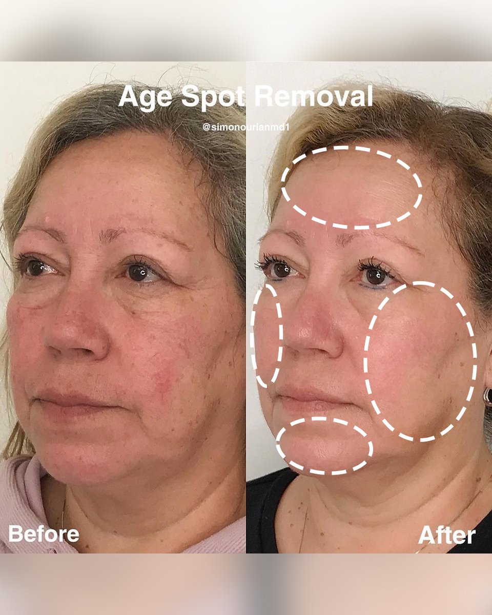 Dr. Simon Ourian - Epione tweet media