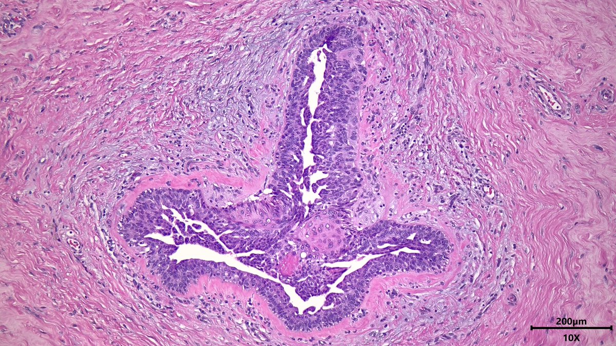 VickeryJasmine's tweet photo. Reactive squamous metaplasia in the breast duct of a male with usual ductal hyperplasia (gynecomastia) #breastpath #pathx #pathtwitter #pathresidents https://t.co/kPQ2lLYLhD