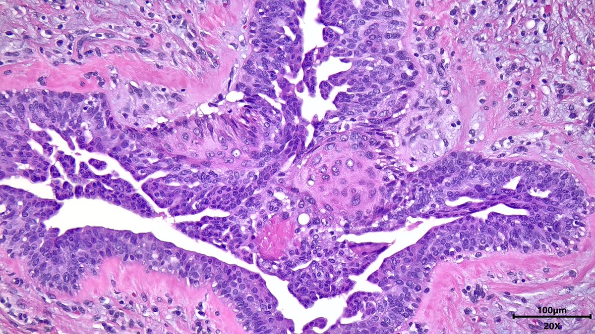 VickeryJasmine's tweet photo. Reactive squamous metaplasia in the breast duct of a male with usual ductal hyperplasia (gynecomastia) #breastpath #pathx #pathtwitter #pathresidents https://t.co/kPQ2lLYLhD