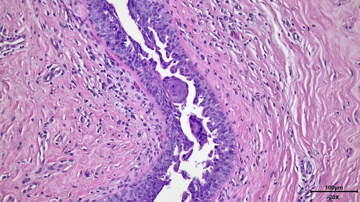 VickeryJasmine's tweet photo. Reactive squamous metaplasia in the breast duct of a male with usual ductal hyperplasia (gynecomastia) #breastpath #pathx #pathtwitter #pathresidents https://t.co/kPQ2lLYLhD