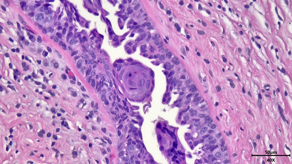 VickeryJasmine's tweet photo. Reactive squamous metaplasia in the breast duct of a male with usual ductal hyperplasia (gynecomastia) #breastpath #pathx #pathtwitter #pathresidents https://t.co/kPQ2lLYLhD