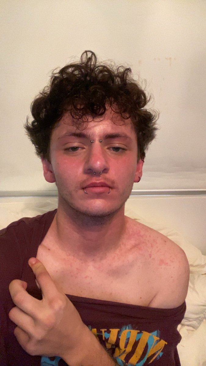 in0suki's tweet photo. wow throwback to exactly one year ago, FUCK lamotrigine. i ended up in hospital for 3 days :’) https://t.co/fetvVsgBW3