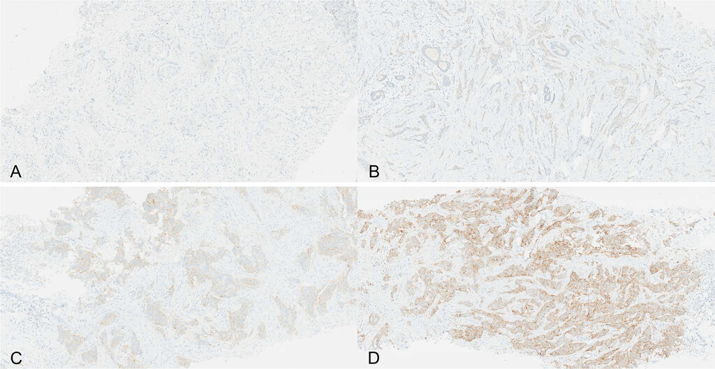 ArchivesPath's tweet image. New in Archives: Clinicopathologic Features and Genomic Profile of Human Epidermal Growth Factor Receptor 2–Low and Human Epidermal Growth Factor Receptor 2–Ultra low Invasive Breast Carcinomas. Check it out here 👉 doi.org/10.5858/arpa.2…

#CAP #Archives #Pathology