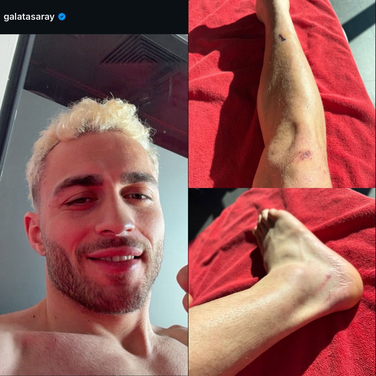 kerem saç kaybı tweet media