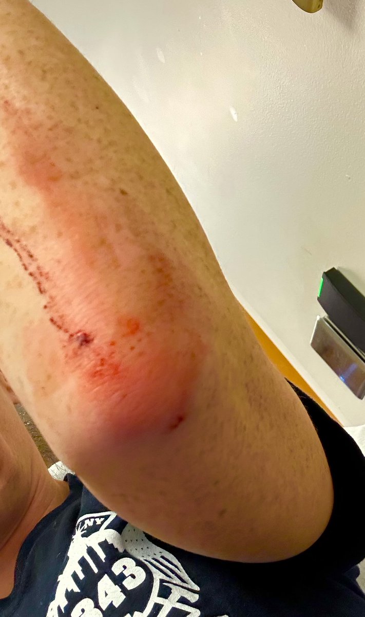 scooperon7's tweet photo. Tonight on 7News woman who was meeting up with a man she was planning to sell a diamond to at the Natick Mall shows us her injuries after she says he took the diamond and tried to take off…she held on to him before 2 hero’s jumped into action to stop the suspect #7News https://t.co/hIIvrdmvWO