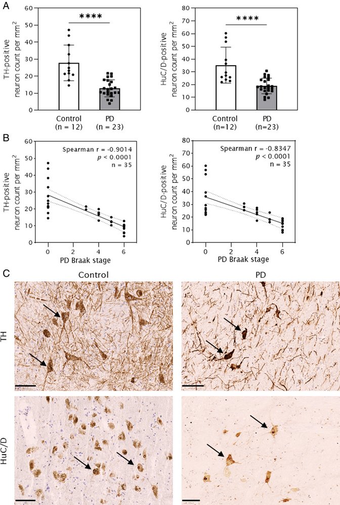 ScienceofPD's tweet photo. Neuropath. &amp; molecular analyses on 47 postmortem substantia nigra samples implicate ferroptosis (&amp; to a lesser extent necroptosis) in #Parkinsons cell death; Researchers propose a “2-hit” model: early  synucleinopathy amplified later by a neuromelanin-iron
https://t.co/4QSZfquNIZ https://t.co/A4an6zsHws
