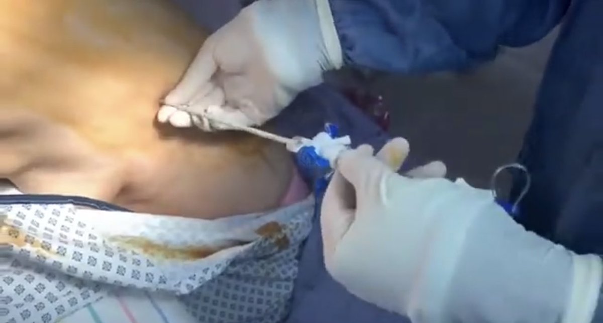 PleuralPOCUS's tweet photo. Guía práctica de Toracocentesis asistida por USG. 🩺🎥

Desde la incisión inicial hasta el drenaje del líquido pleural. Un recurso imprescindible para estudiantes y residentes.

Enlace al video: https://t.co/OscaeuBg9Y 👈 https://t.co/vfQoO94F7y